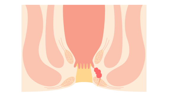 Abscesos perianales Dr. Rafael Olivarría - Proctólogo en Tijuana